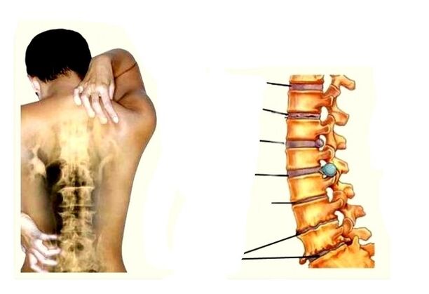 Stadia van ontwikkeling van osteochondrose