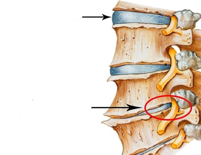 beschadigde schijf en inbreuk maken op de zenuw met cervicale osteochondrose