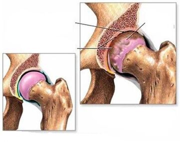 Arthrose van het heupgewricht