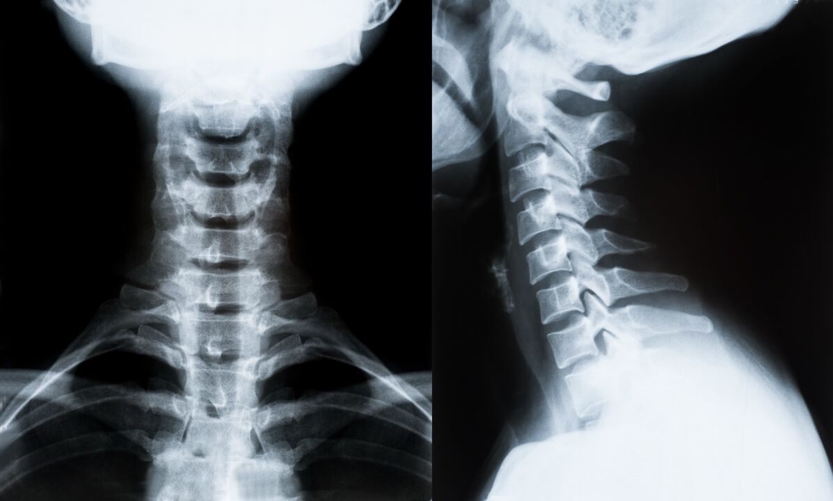cervicale osteochondrose op röntgenfoto